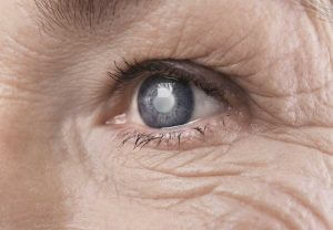 cataract eye close up