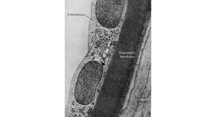 diagram of fuchs dystrophy endothelial cells