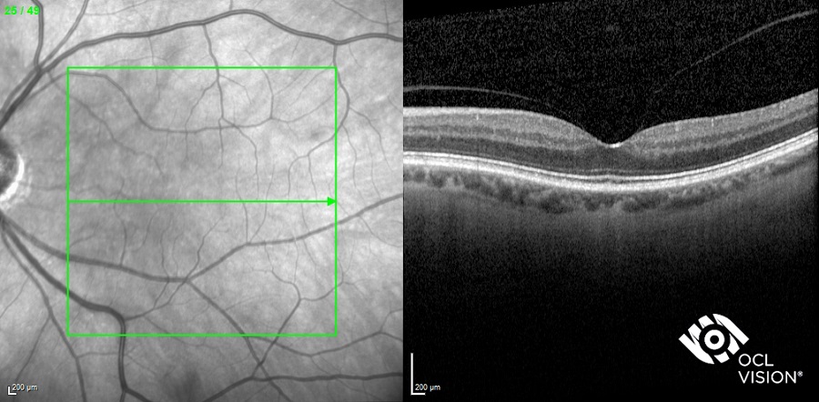 Fig 1a. Normal macula