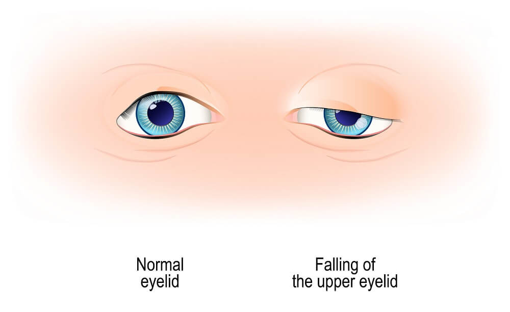 ptosis surgery (droopy eyelid)