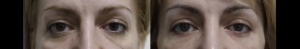 Lower blepharoplasty before and after 3